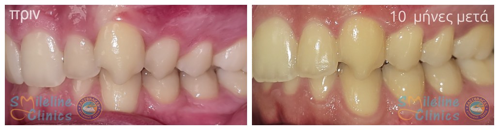 Περιστατικό 84