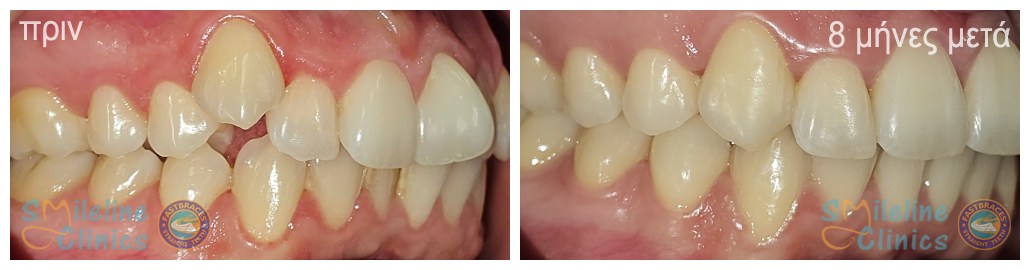 Περιστατικό 85