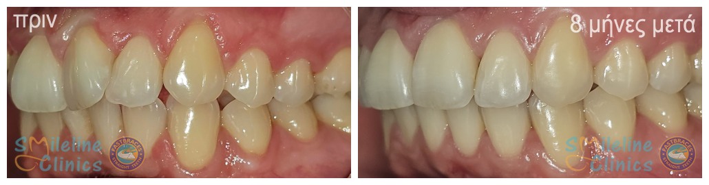 Περιστατικό 85