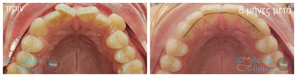 Περιστατικό 85