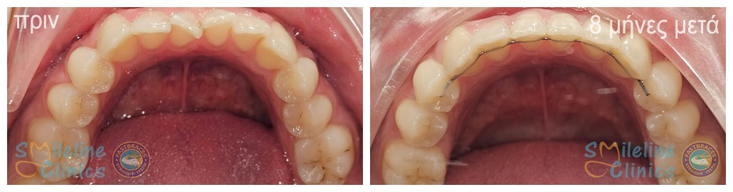 Περιστατικό 85