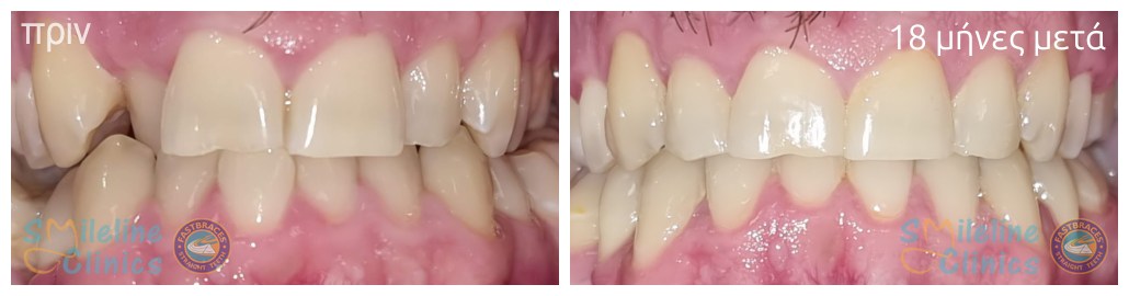 Περιστατικό 87
