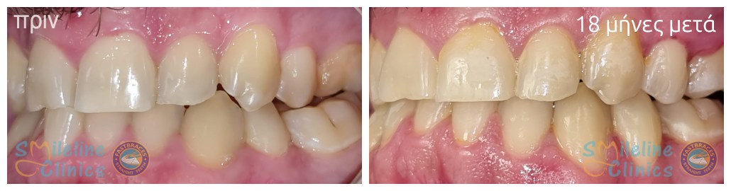 Περιστατικό 87