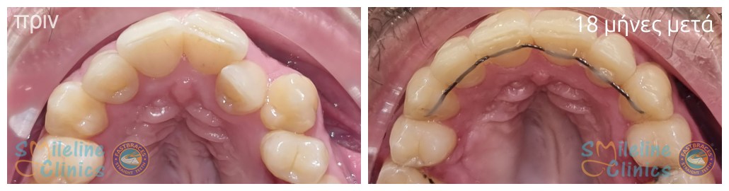 Περιστατικό 87