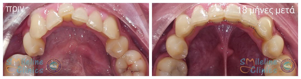 Περιστατικό 87