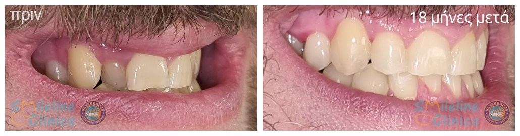 Περιστατικό 87