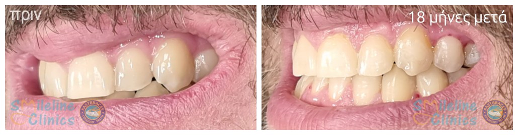 Περιστατικό 87