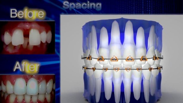 Fastbraces® γρήγορα σιδεράκια Πριν και Μετά