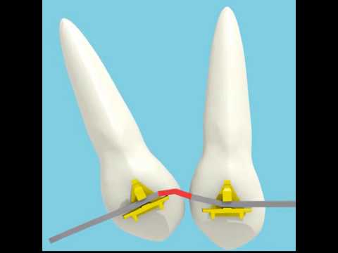 Μετακίνηση ρίζας απο την αρχή της θεραπείας 1