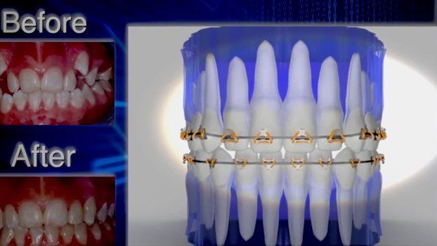 Πως η αρχιτεκτονική διαφορά λύνει εύκολα τα περισσότερα ορθοδοντικά προβλήματα