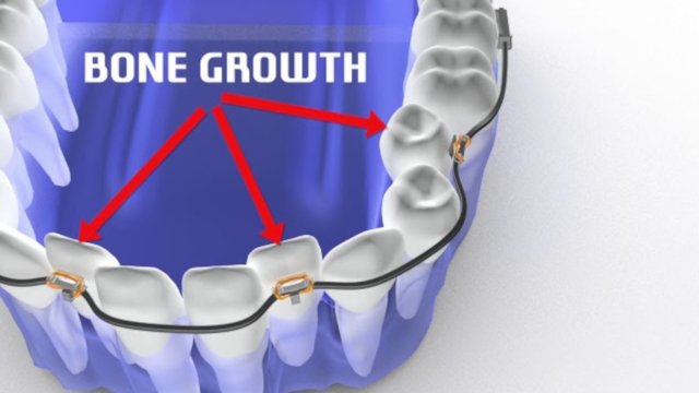 Δημιουργία οστού-χώρου