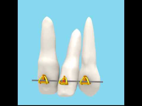 Μετακίνηση ρίζας απο την αρχή της θεραπείας 2