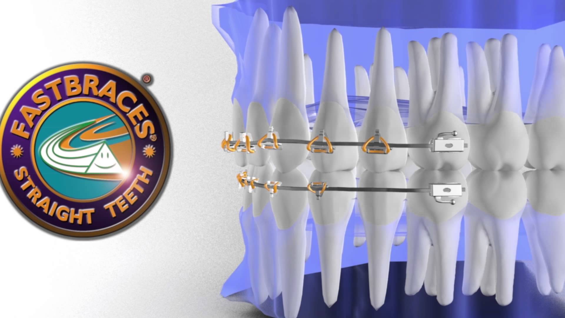 Η διαφορά του συστήματος Fastbraces®